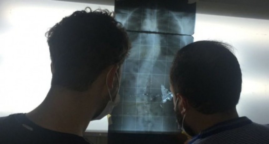 Escoliosis: Cuáles son las señales que deben motivar la consulta