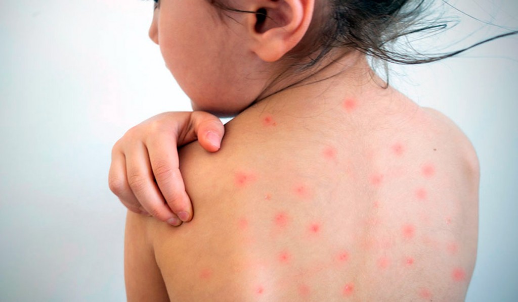 La vacunación, herramienta fundamental para prevenir el sarampión