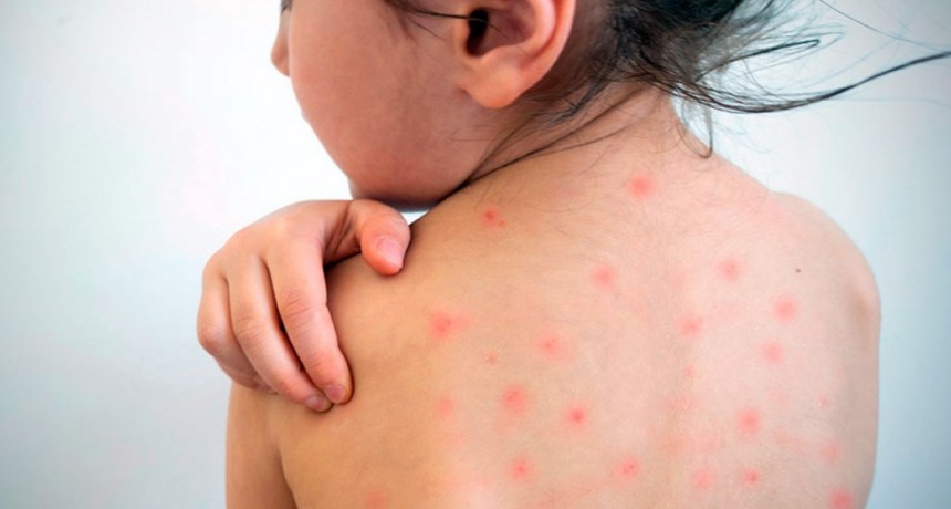 La vacunación, herramienta fundamental para prevenir el sarampión