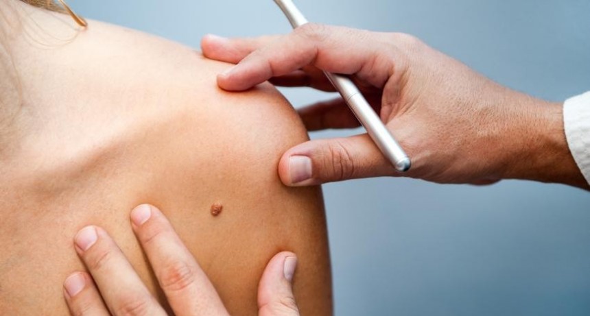 Ituzaingó: Campaña de prevención del cáncer de piel 